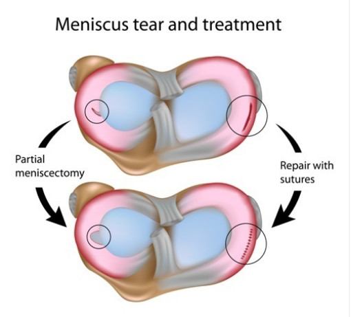 Torn Meniscus Tear